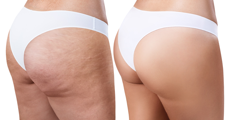 Massagem para Celulite com Bambu